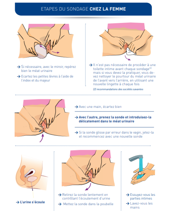 Etape sondage chez la femme