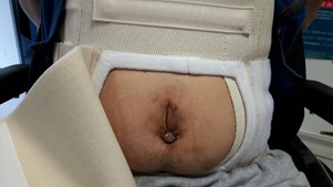 v%C3%A9sico_spincterienne_sondage-6ada0a36 Les adaptations pour optimiser la gestion v&eacute;sico sphinct&eacute;rienne