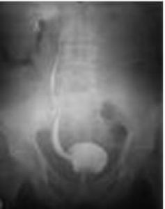 art.v1_suivi-des-vessies-b25cc96d Suivi des vessies neurologiques