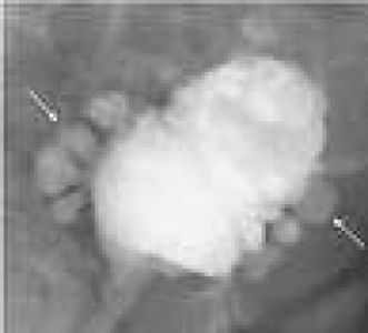 art.v2_suivi-des-vessies-d4581c5d Suivi des vessies neurologiques